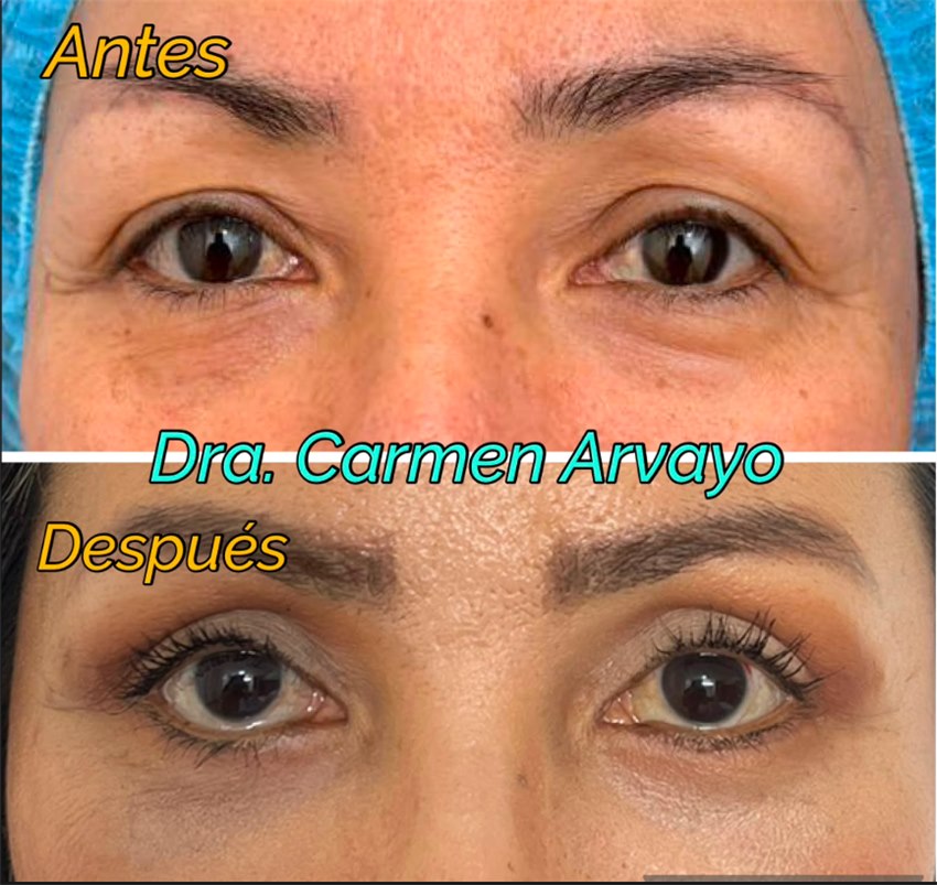 Resultado real de blefaroplastia por la Dra. Carmen Arvayo